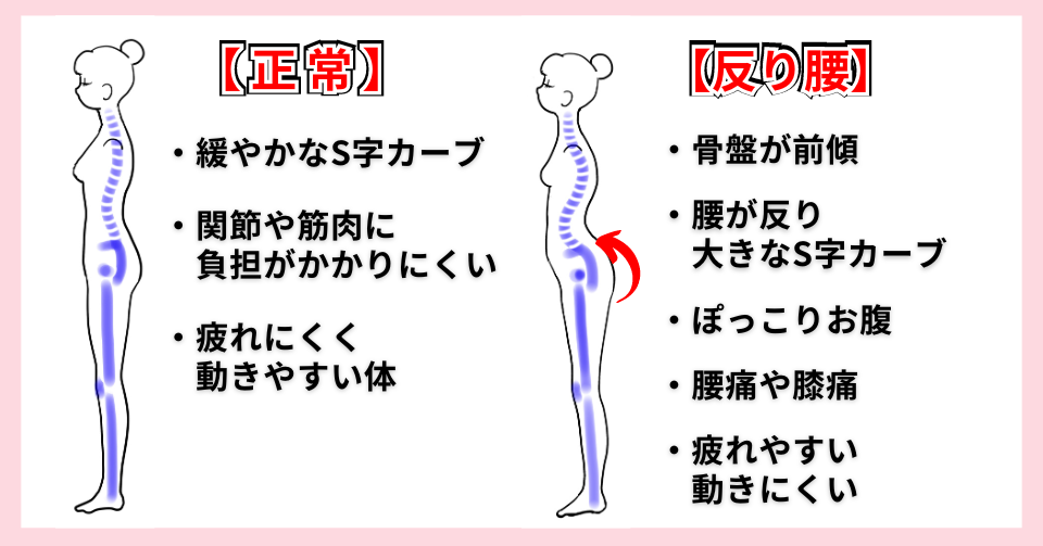 反り腰ってどんな状態？