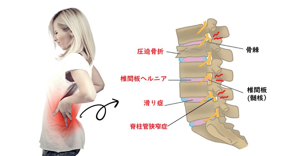 反り腰が影響して起こる関節疾患